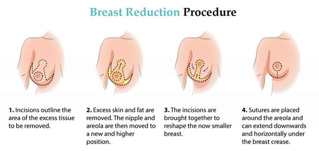 Breast aesthetic surgery